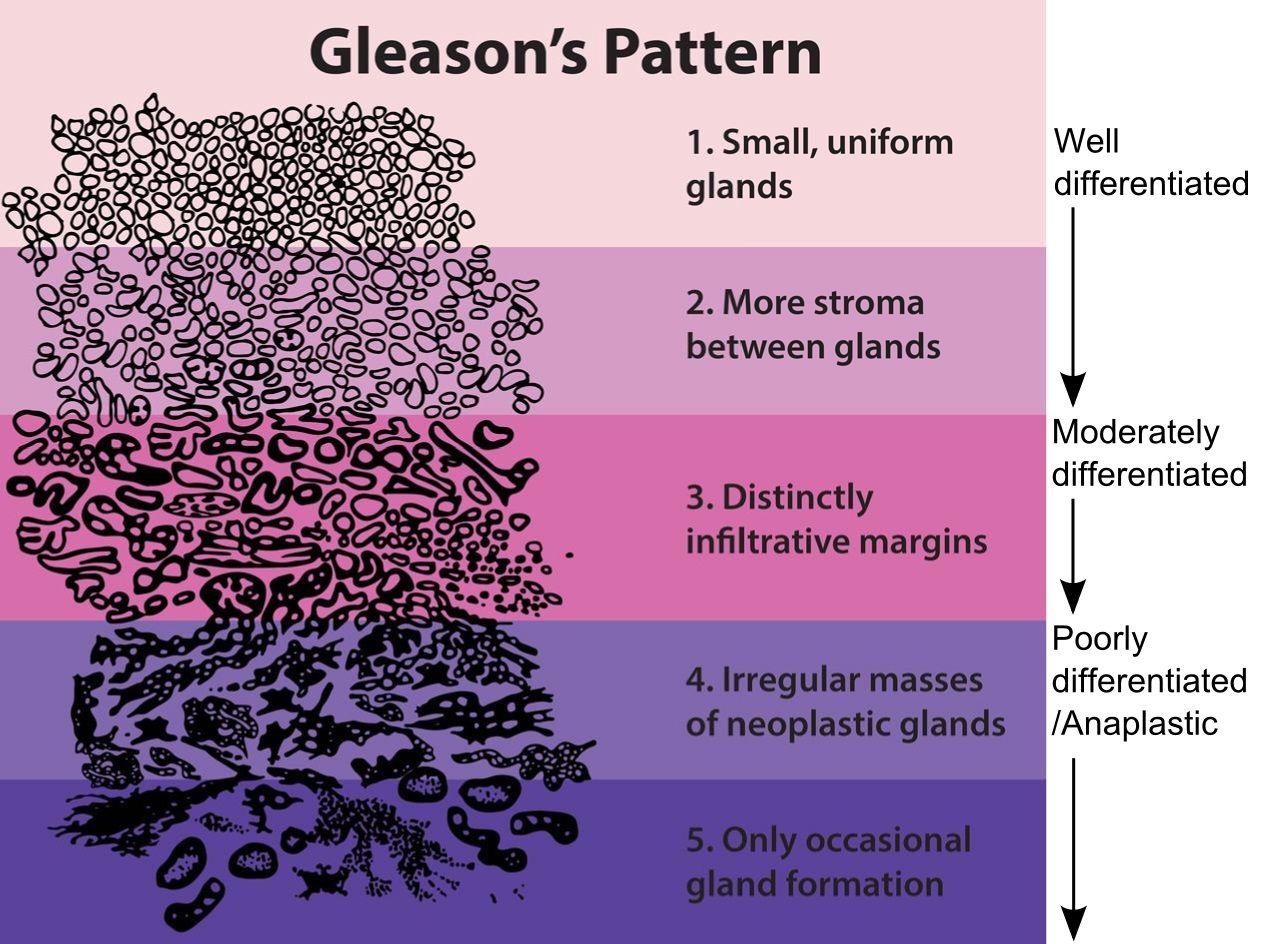 The classic Gleason drawing: five stacked bands of gland outlines running from small uniform glands at the top to barely any gland formation at the bottom, labelled well to poorly differentiated.