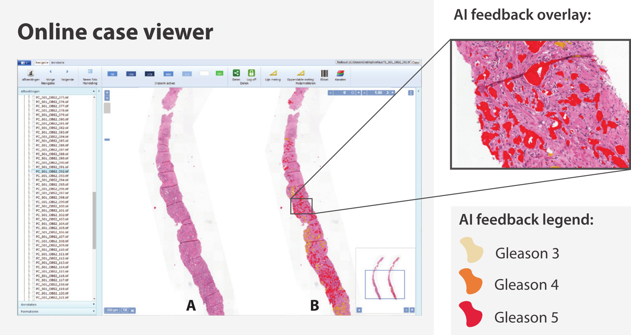 Screenshot of the online case viewer: the same prostate biopsy shown twice, plain on the left and with the AI overlay on the right, with a legend mapping yellow, orange and red to Gleason patterns 3, 4 and 5, and a zoomed detail of the marked glands.