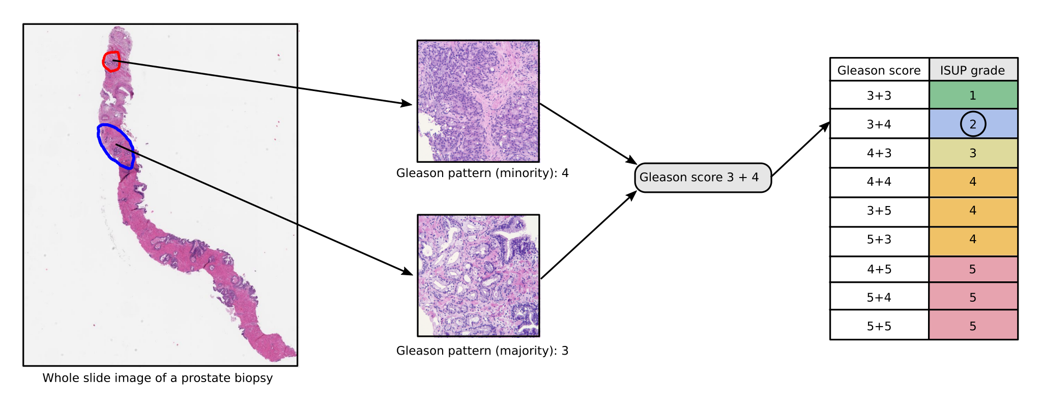 A prostate biopsy with two circled regions leading to close-ups of a minority Gleason pattern 4 and a majority pattern 3, combining into a Gleason score of 3 + 4, which a table maps to ISUP grade group 2.