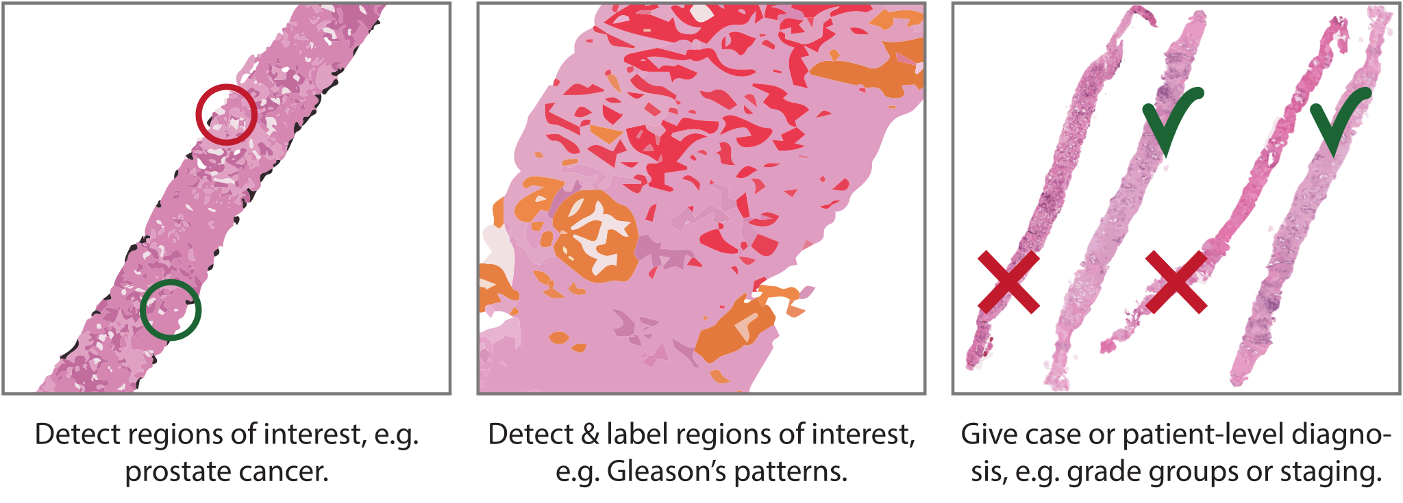 Three panels of the same biopsy: circled regions of interest, then the tissue coloured in by Gleason pattern, then whole biopsies ticked or crossed for a case-level diagnosis.