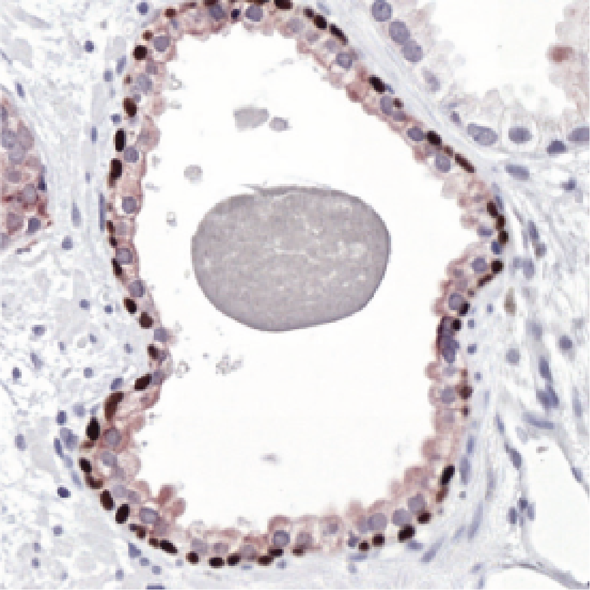 Close-up IHC image of a prostate gland with a brown-stained epithelial rim around a solid gray oval concretion inside the lumen.