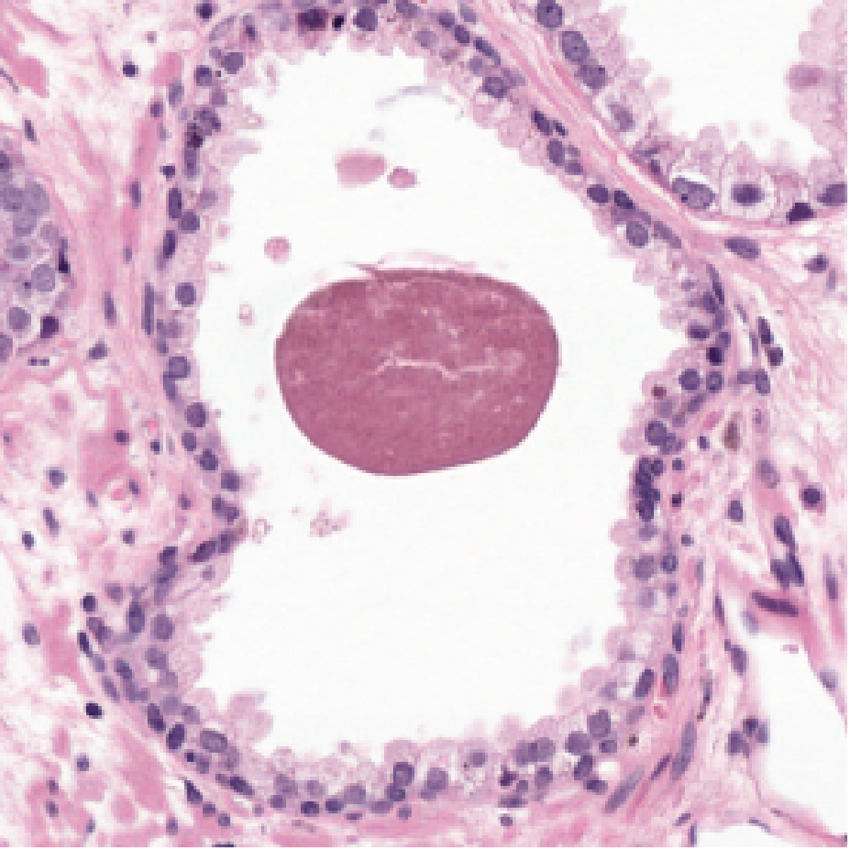 The same gland in H&E, with a pink epithelial rim around a laminated maroon concretion inside the lumen.