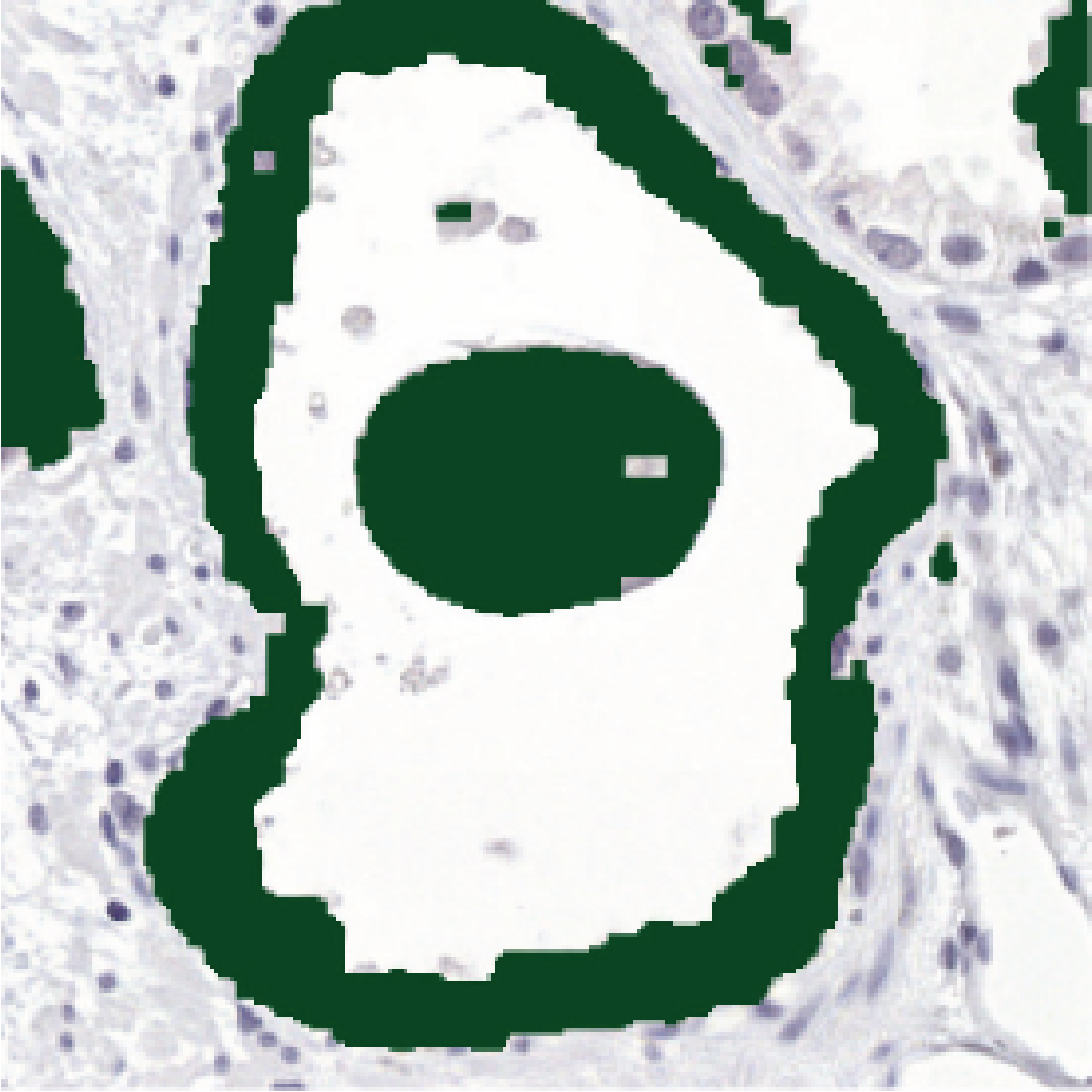 Color deconvolution output of the gland: a green mask wrongly covers both the epithelial rim and the concretion in the lumen.