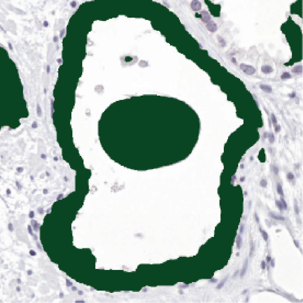 Uncorrected IHC network prediction of the same gland, with the concretion still wrongly included in the green epithelium mask.