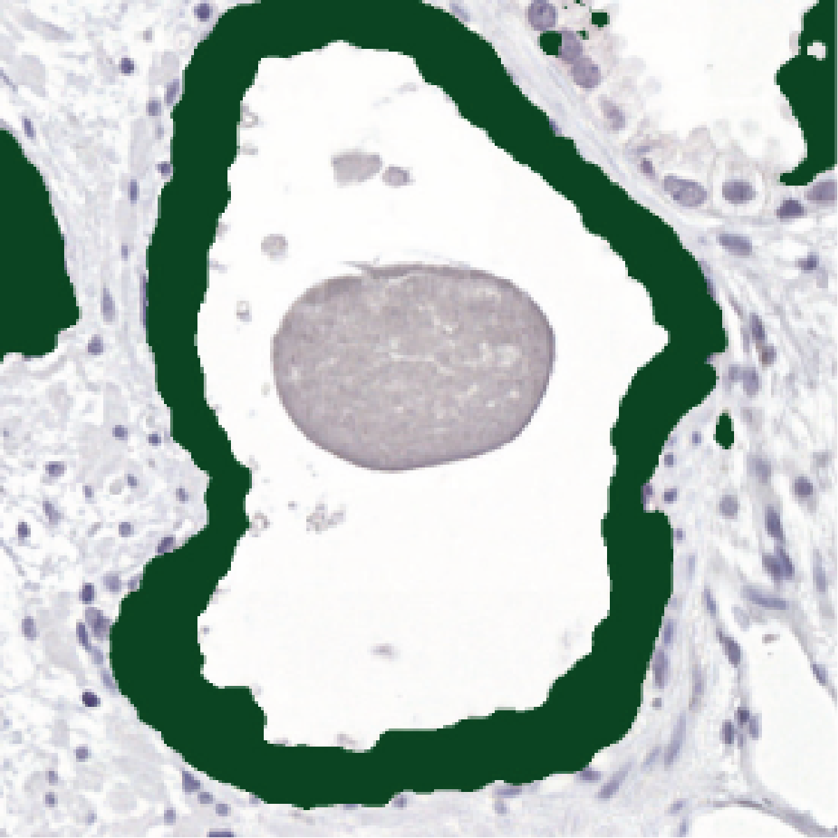Corrected IHC network prediction of the same gland, correctly leaving the gray concretion outside the green epithelium mask.