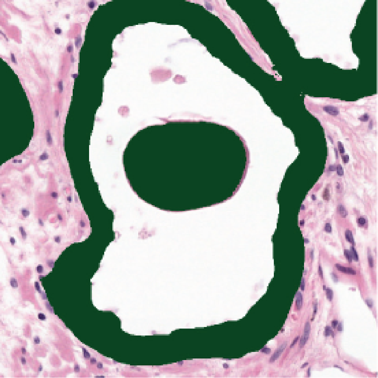 Uncorrected H&E network segmentation of the gland in H&E, again wrongly covering the maroon concretion in the green mask.