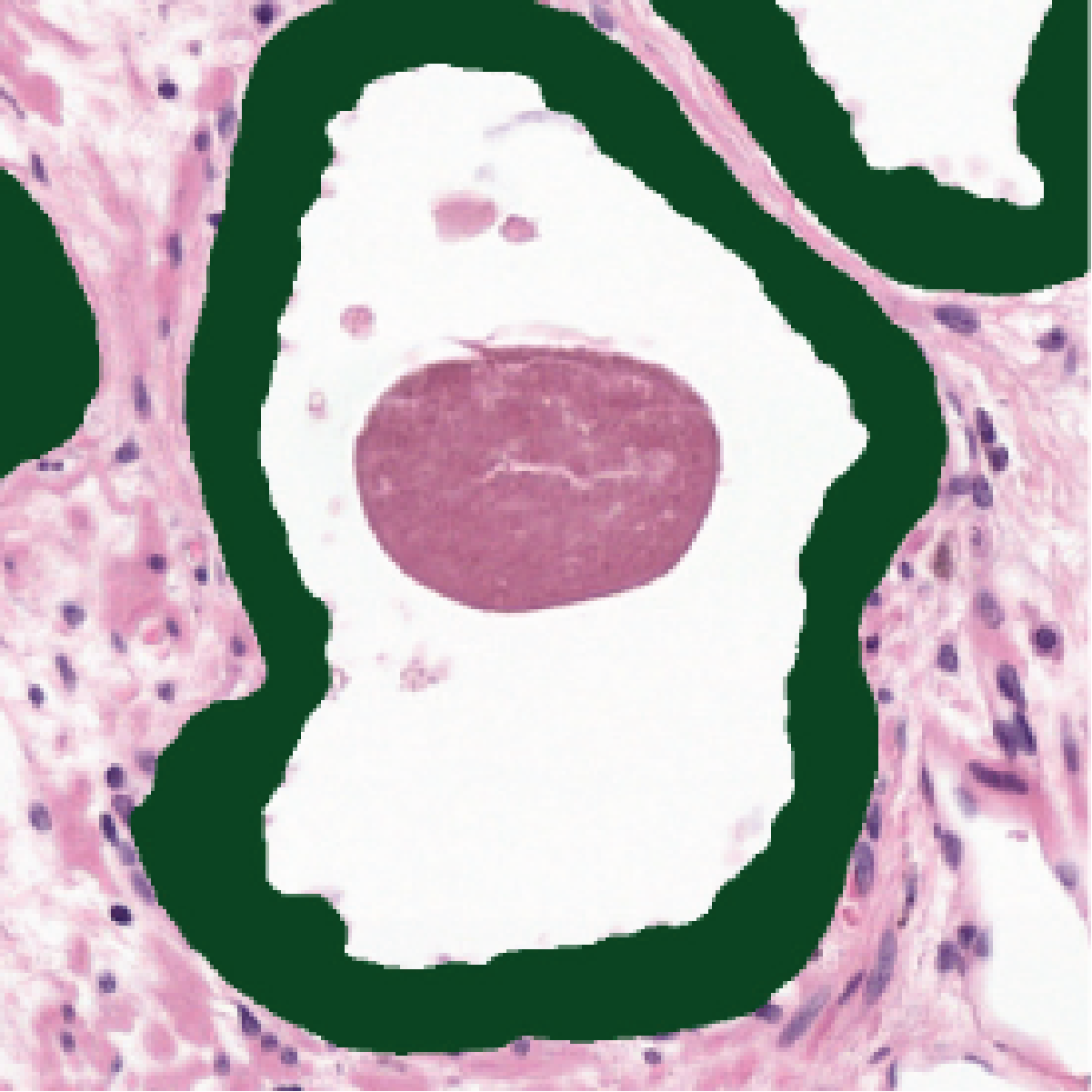 Corrected H&E network segmentation of the same H&E gland, correctly leaving the maroon concretion unmarked.