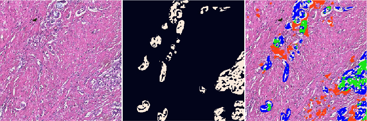 Triplet of an external test-set H&E region with sparse small glands in dense stroma, its ground-truth mask, and a segmentation overlay dominated by blue false negatives, showing the network under-segmenting the tissue.