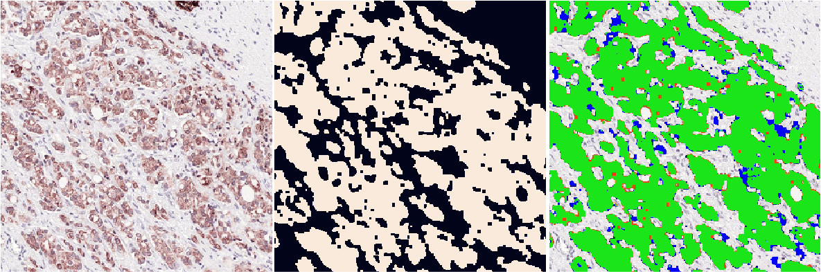 Triplet of a densely stained IHC gland region, its binary ground-truth epithelium mask, and the IHC network's segmentation overlay, almost entirely green with only a few small red and blue errors.