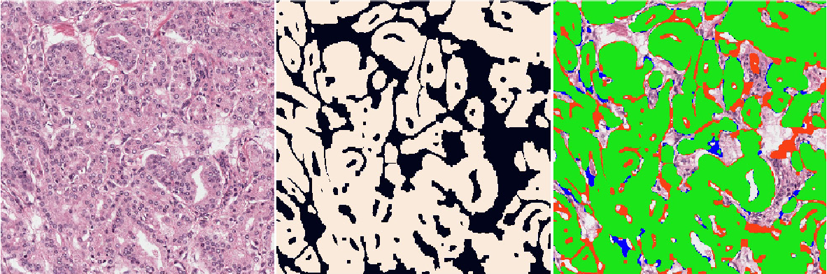 Triplet of a second H&E region of Gleason pattern 4 prostate cancer with irregular fused glands, its ground-truth mask, and a segmentation overlay with a notable red false-positive area between glands.