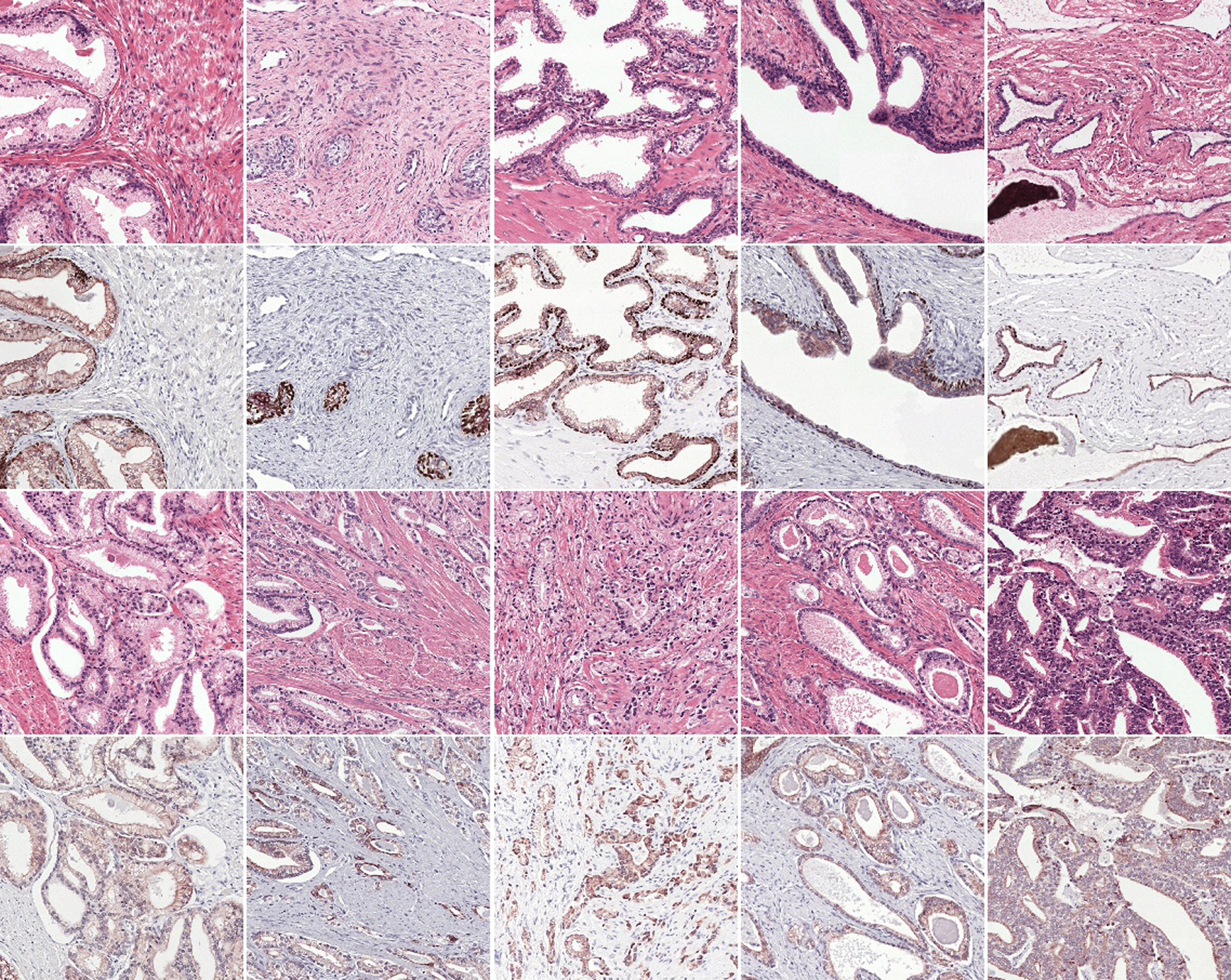 Grid of ten H&E and IHC image pairs of prostate tissue in four rows, showing benign glands and increasing Gleason grades, with epithelium stained brown and the basal cell layer stained dark red in the IHC rows.