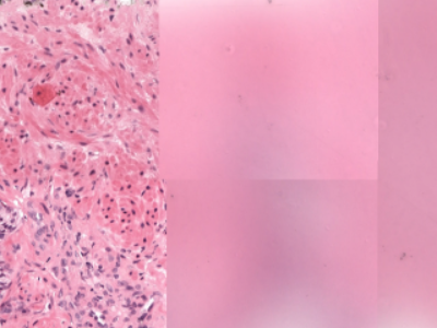 Pink tissue that is sharp on the left and dissolves into blur across the right two-thirds of the frame.