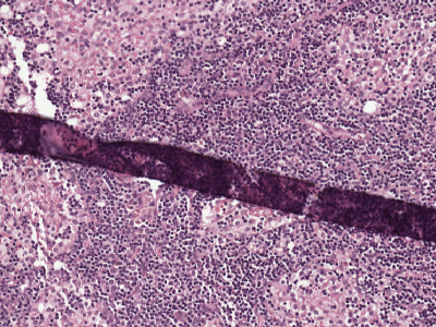 A dark, well-demarcated band cuts diagonally across otherwise even purple tissue where the section has folded over itself.