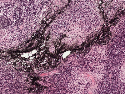 Black ink smeared in a broad band across the tissue, obscuring the cells underneath.