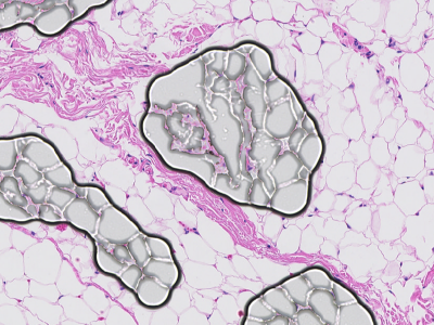 Fat tissue crossed by several dark-rimmed rounded outlines where air bubbles are trapped under the coverslip.