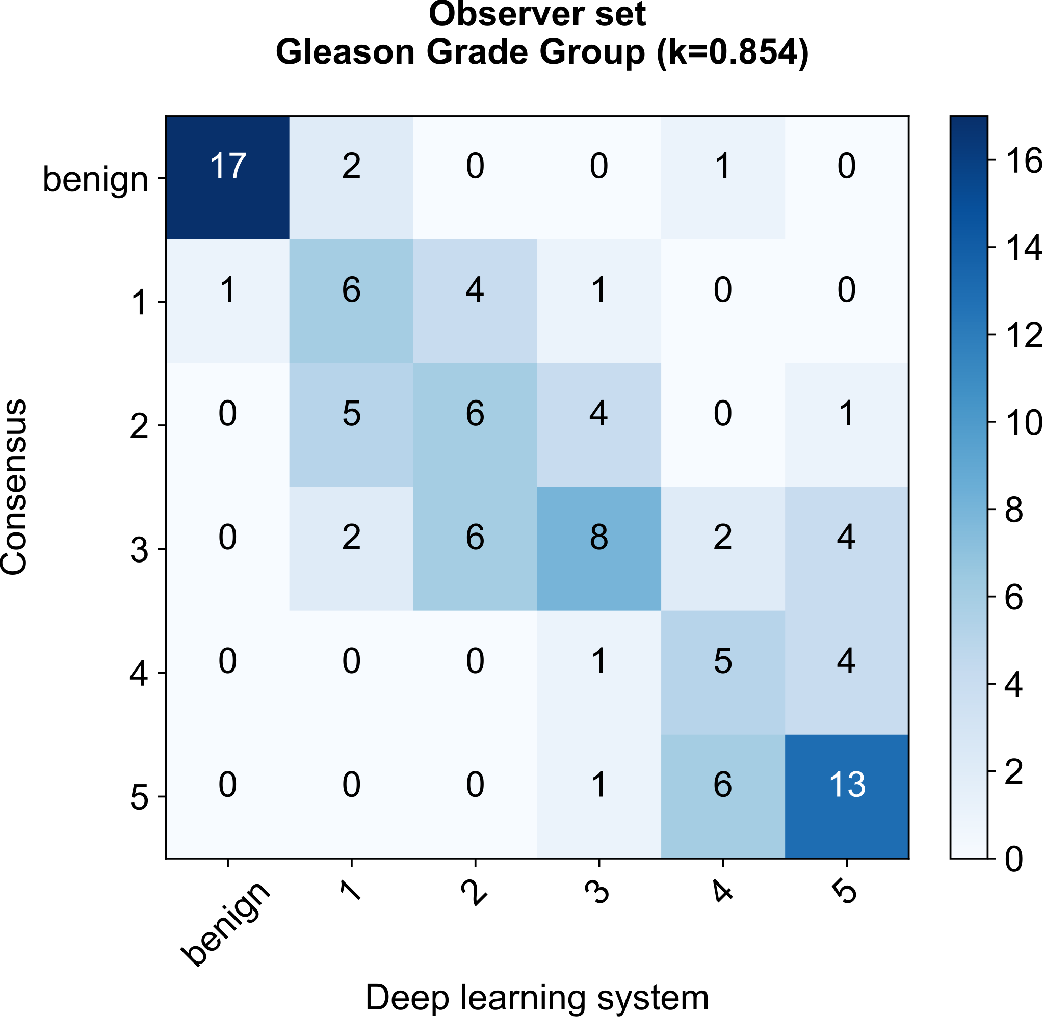Confusion matrix of grade group counts on the 100-case observer set, consensus versus deep learning system, kappa 0.854.
