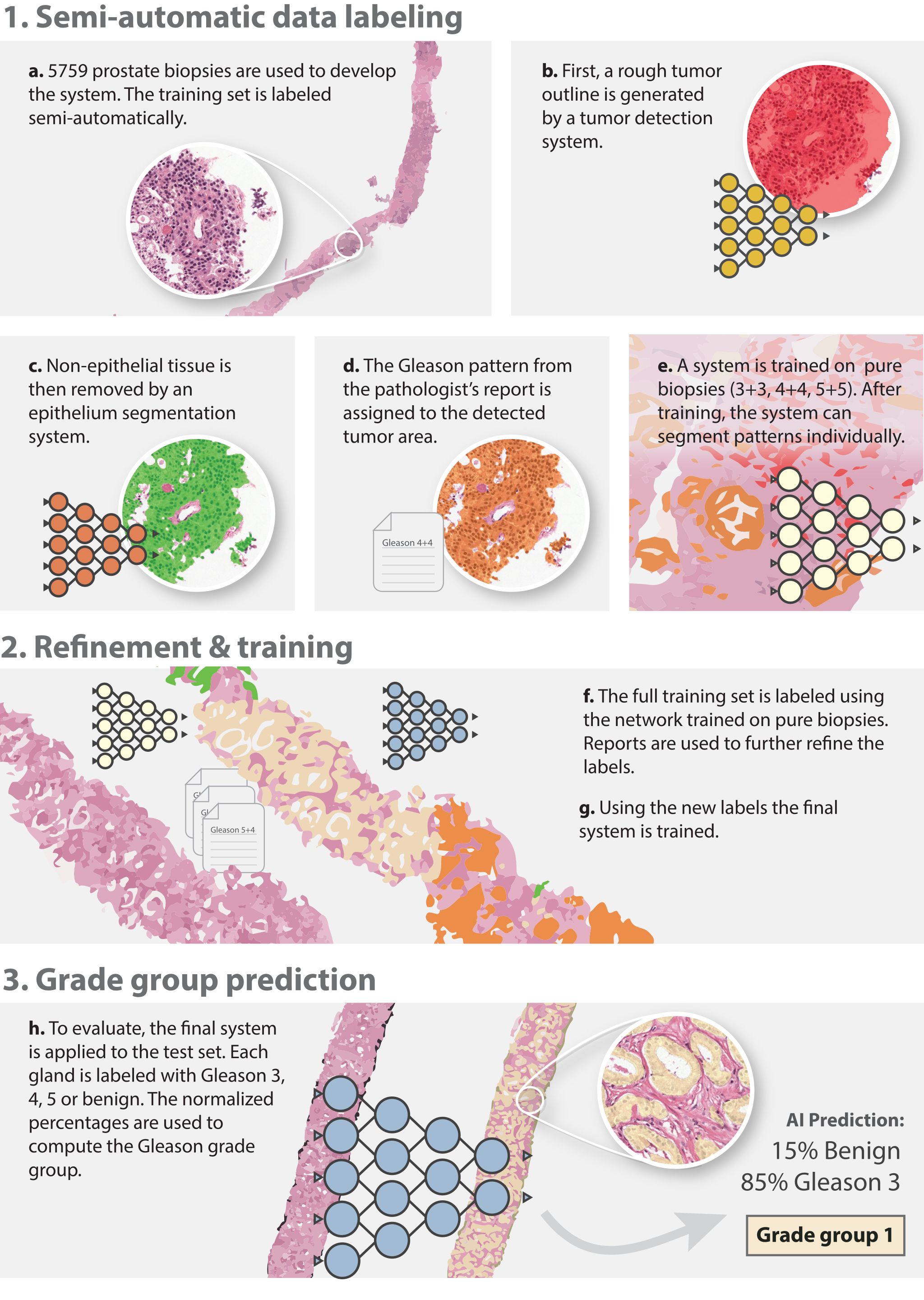 Nine-panel infographic (a-h) illustrating the three-stage pipeline: semi-automatic data labeling from tumor detection and epithelium segmentation, refinement and training on the full dataset, and grade-group prediction from a worked example ending in Grade group 1.