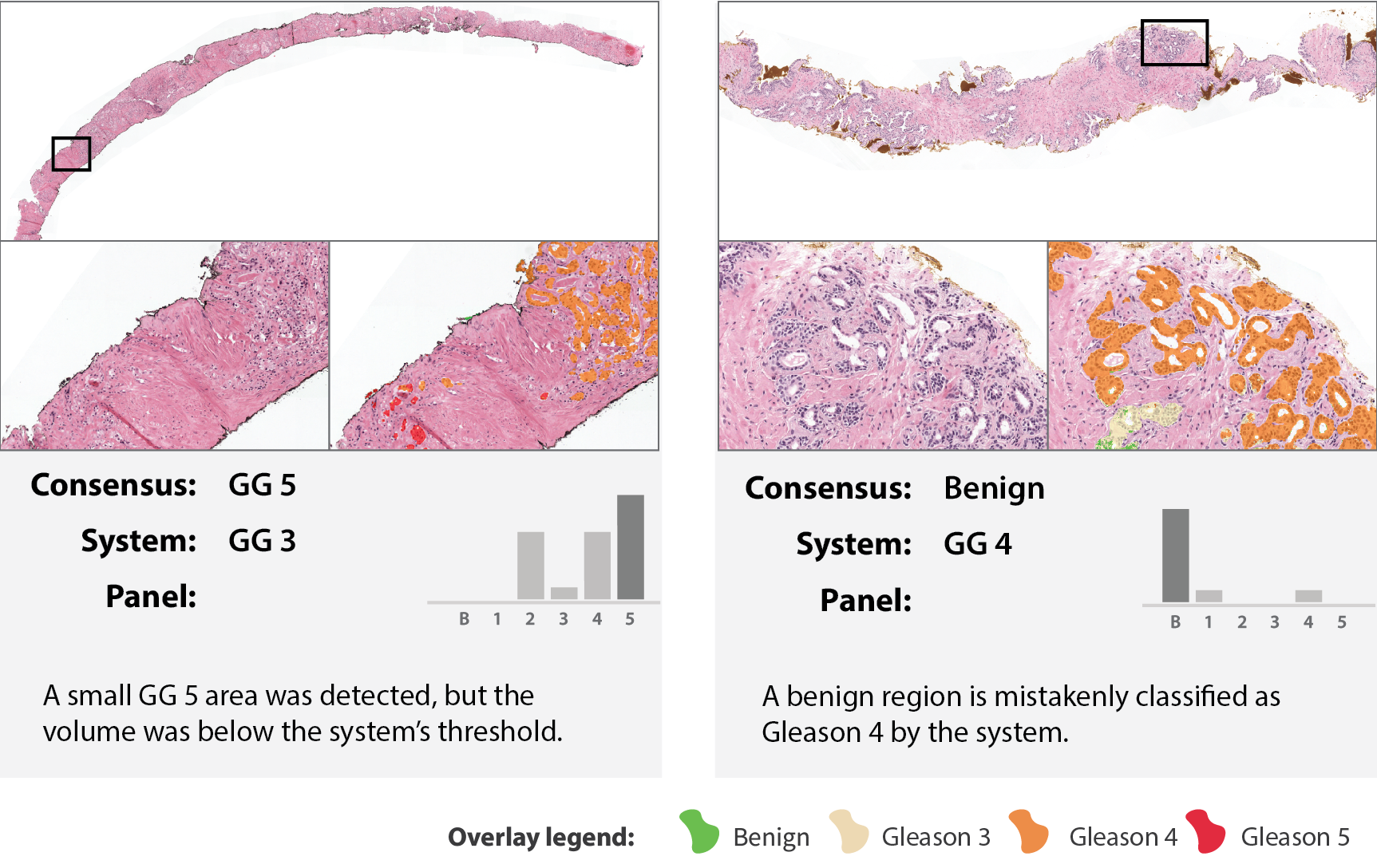 Two failure cases: a grade-group-5 biopsy where the system under-called a small high-grade area as grade group 3 because its volume fell below threshold, and a benign biopsy where the system over-called a region as grade group 4.