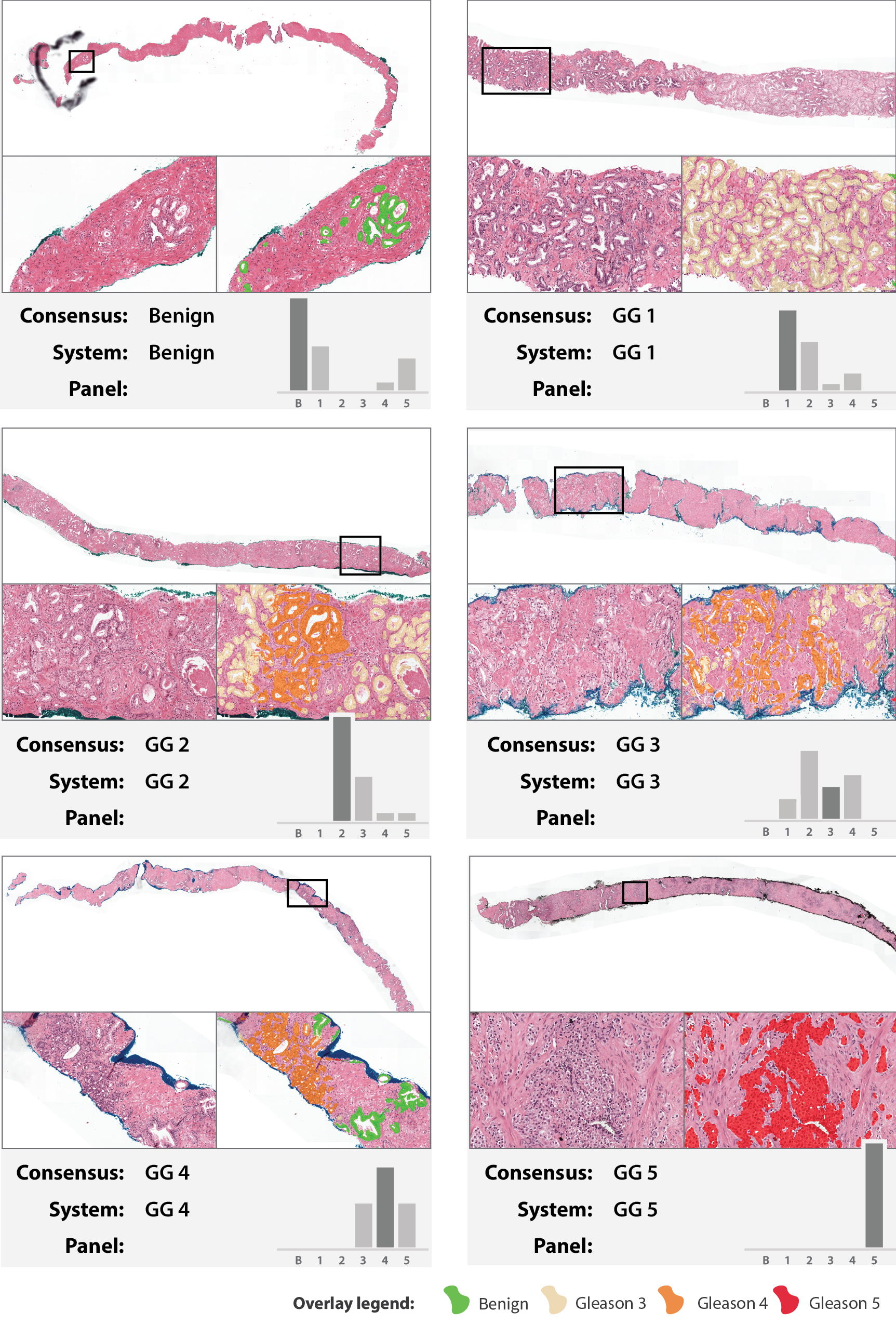 Six example biopsies spanning benign through grade group 5, each showing the whole-slide thumbnail, a zoomed detail with and without the system’s colored Gleason-pattern overlay, and a bar chart comparing the panel’s grade-group votes to the consensus and system calls.