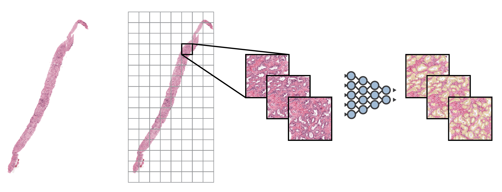 A whole biopsy is overlaid with a grid, one square is pulled out as a stack of small tissue patches, fed through a neural network, and returned as the same patches with tissue coloured in.