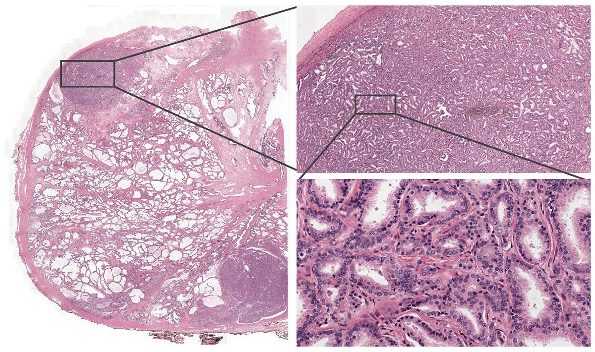 A whole prostate section in pink H&E stain, with two successive zoom-ins ending on individual glands lined by dark-blue nuclei.