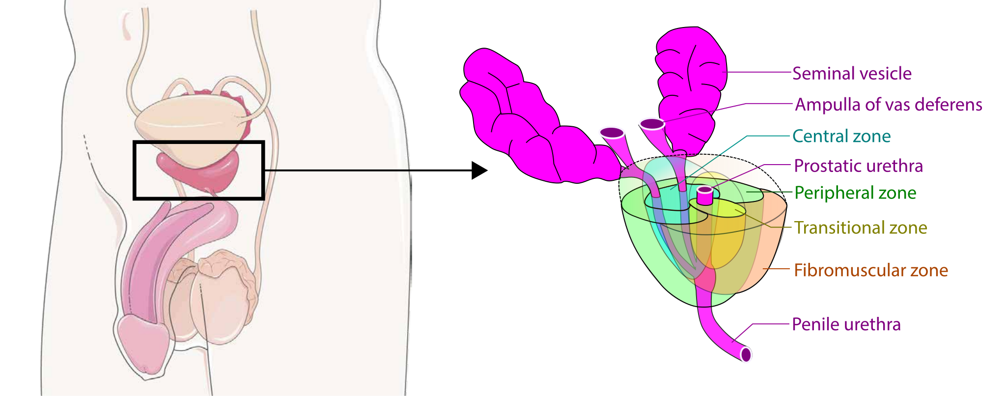 A diagram of the male pelvis with the prostate boxed, beside an enlarged colour-coded prostate showing the seminal vesicles and the central, peripheral, transitional and fibromuscular zones around the urethra.