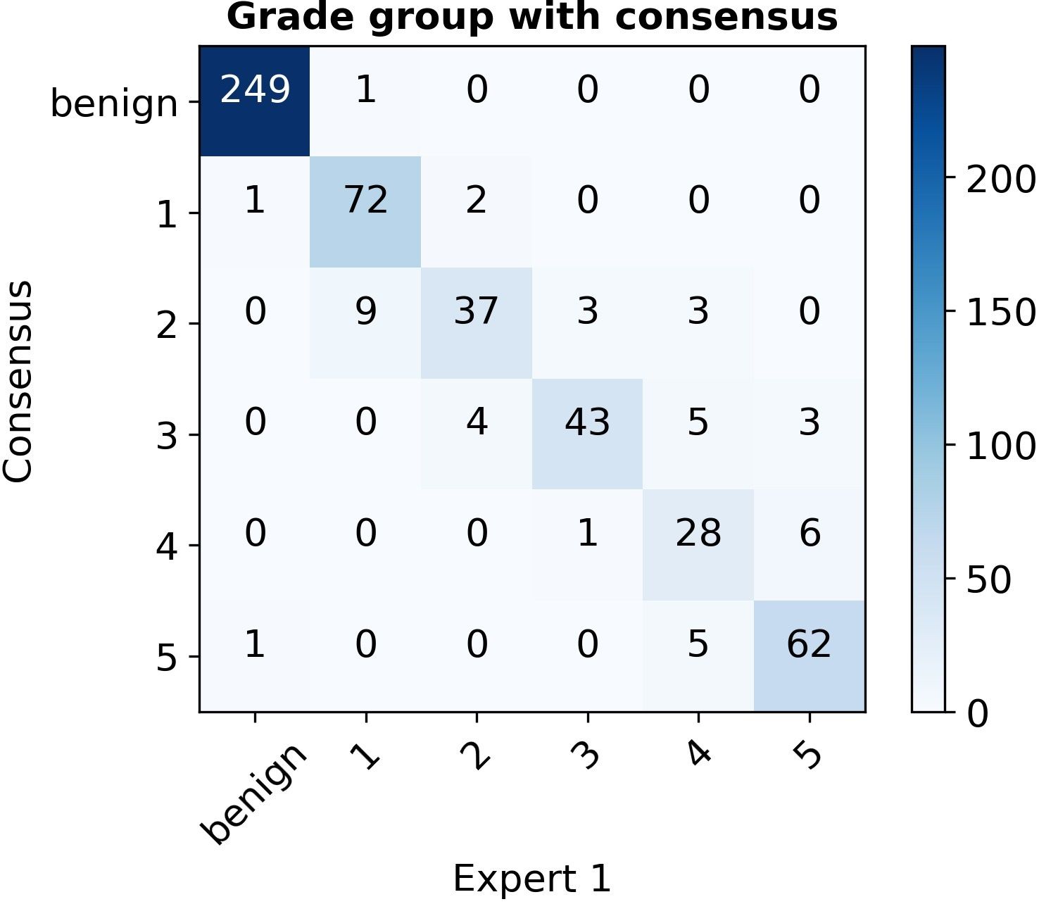 Confusion matrix of grade-group counts, consensus versus Expert 1, with a strong diagonal and 249 of 250 benign cases agreeing.