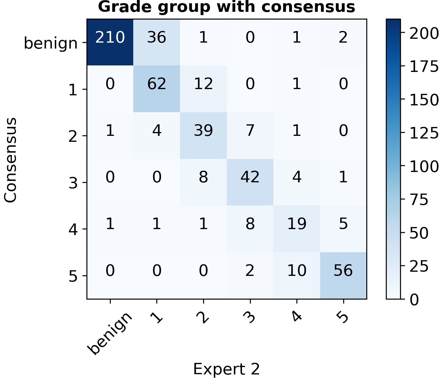 Confusion matrix of grade-group counts, consensus versus Expert 2, showing more off-diagonal spread at grade group 1 (36 cases called benign) than the other two experts.