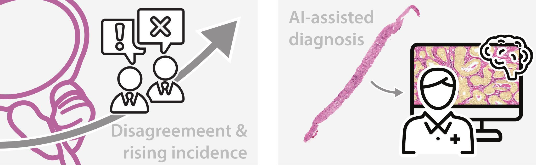 A two-panel pictogram: on the left two pathologists disagree over a prostate against a rising arrow; on the right a biopsy feeds an AI-assisted pathologist reading tissue on a screen.
