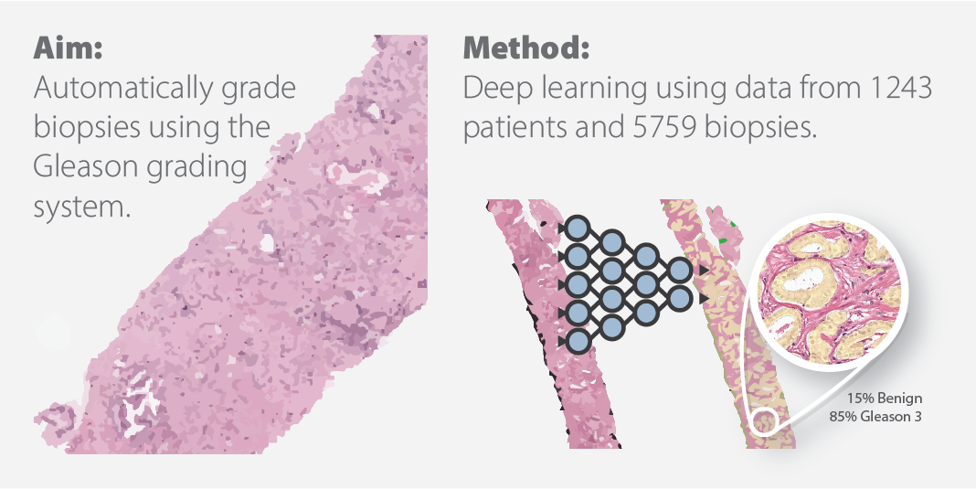 Pathologistlevel Gleason grading using artificial intelligence (AI