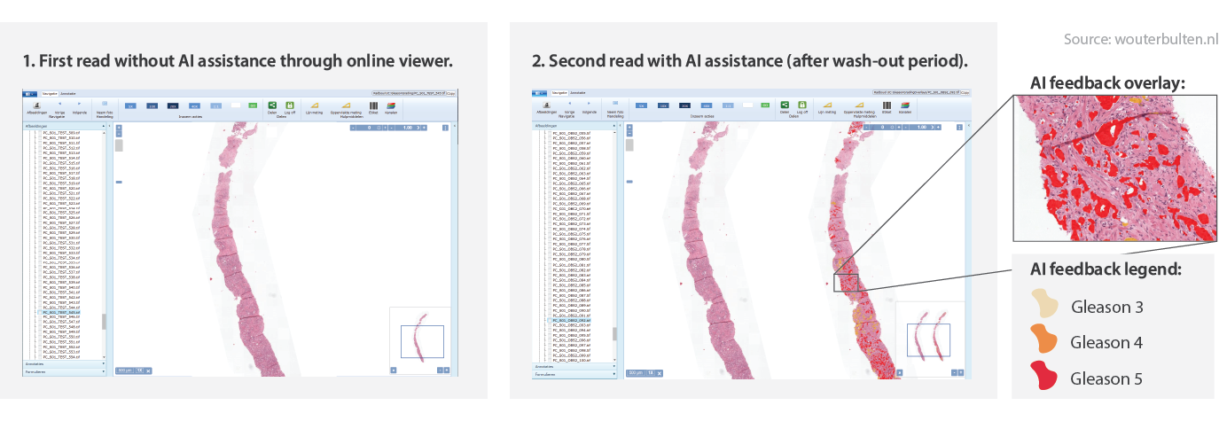 Overview of the study design. In the first read, the panel graded all biopsies without assistance. In the second read, AI assistance was presented next to the biopsy.