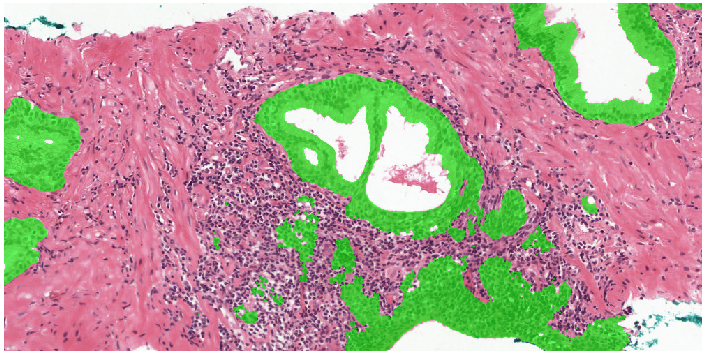 Automated Gleason grading example of a benign area