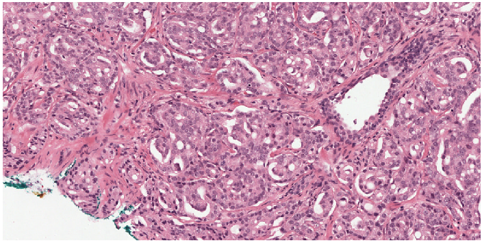 Gleason 4 area from a prostate biopsy