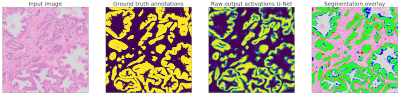 Example of one of the regions of our test set. The network is applied to the input image (1). The ground truth (2) can then be compared with the network output (3). The segmentation overlay (4) shows the performance of the network: green marked pixels show true positive, blue false negative and red false positive.