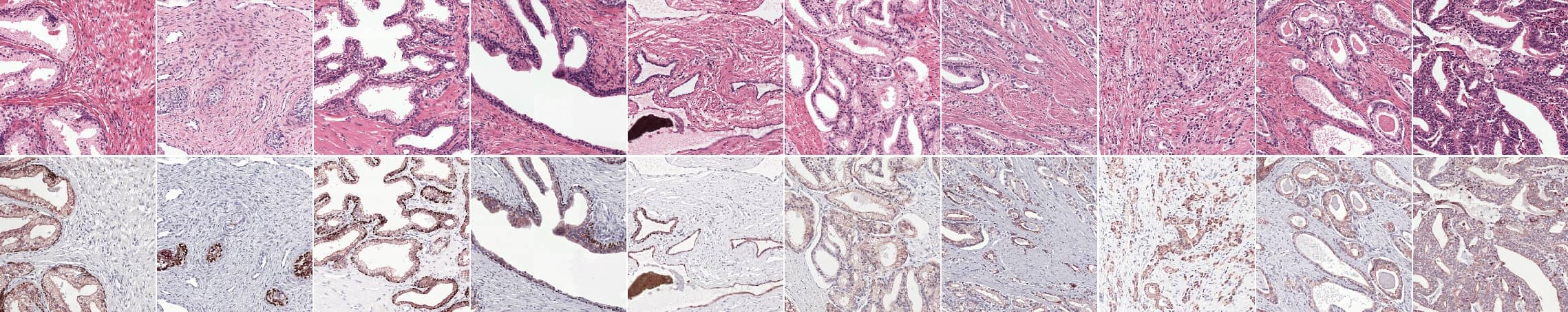 Prostate epithelial tissue can express itself in many forms. The first four columns show examples of benign tissue, the last four of prostate cancer. Top row shows the original H&E, the bottom row IHC.