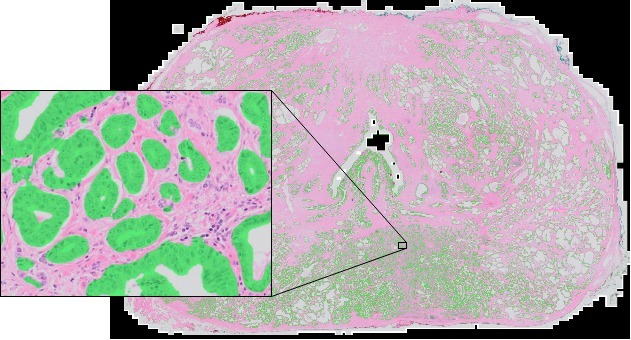 After training the networks can be applied on a whole-slide level, segmenting the full prostate slide. Each slide is extremely large and measures around 200.000 by 100.000 pixels.