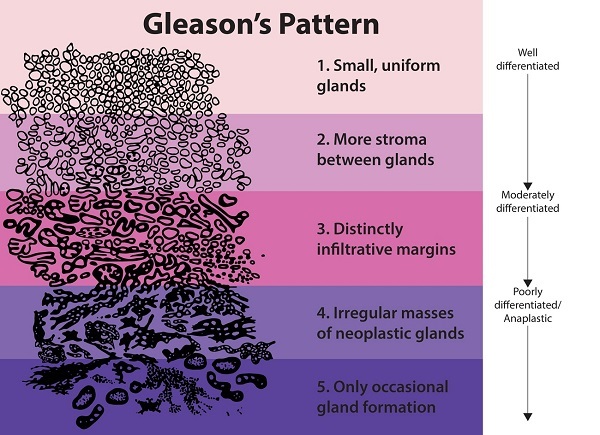 The Gleason scoring system.