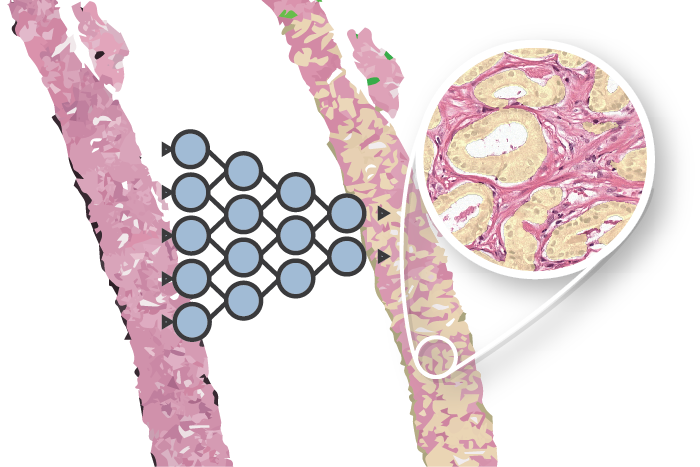 Artificial intelligence as a digital fellow in pathology: human-machine synergy for improved prostate cancer diagnosis